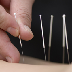 acupuncture